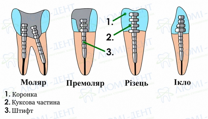 Зубний штифт фото Люмі-Дент
