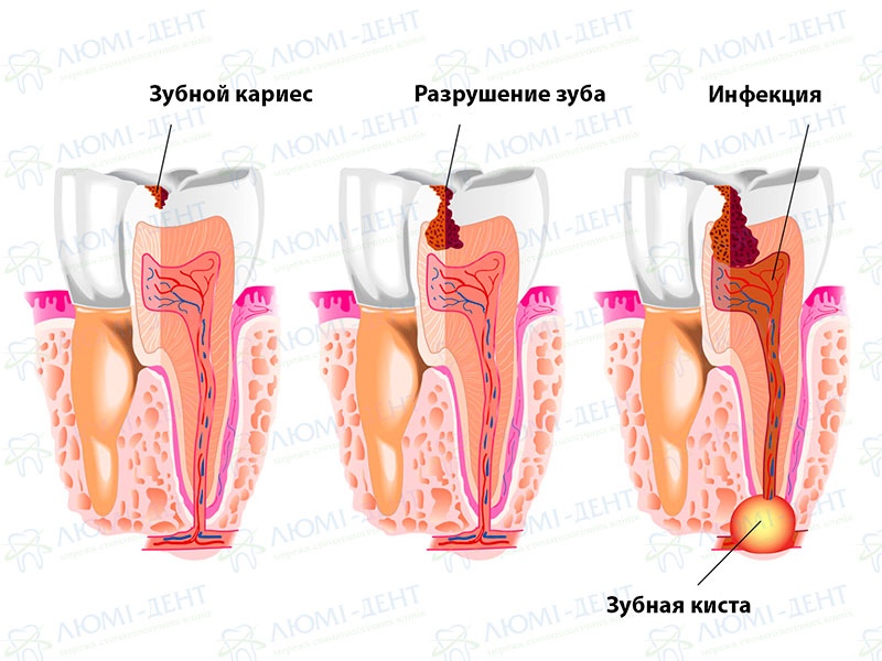 Появление зубной кисты Зубная киста фото Люми-Дент