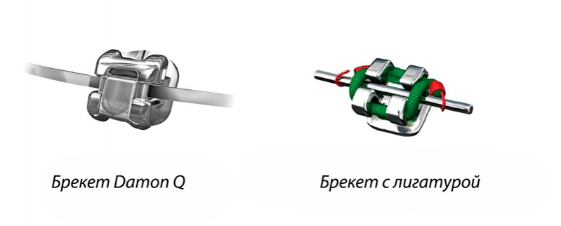 Различие между лигатурным брекетом и безлигатурным Безлигатурные брекет-системы даймон фото Люми-Дент