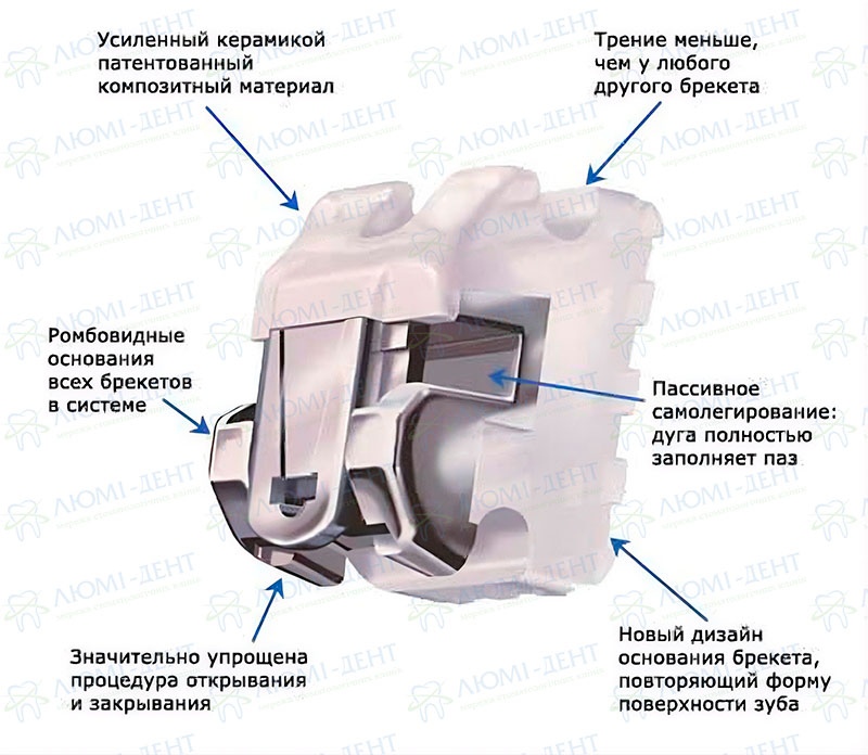 Различие между лигатурным брекетом и безлигатурным Безлигатурные брекет-системы даймон фото Люми-Дент