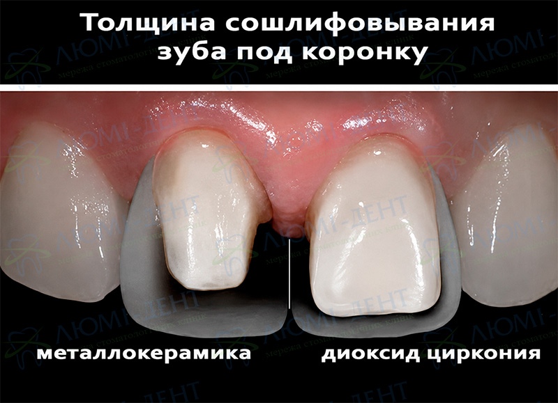 Металлокерамические коронки Киев фото Люми-Дент