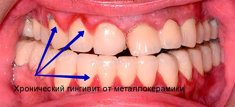 Металлокерамика зубов Киев фото Люми-Дент