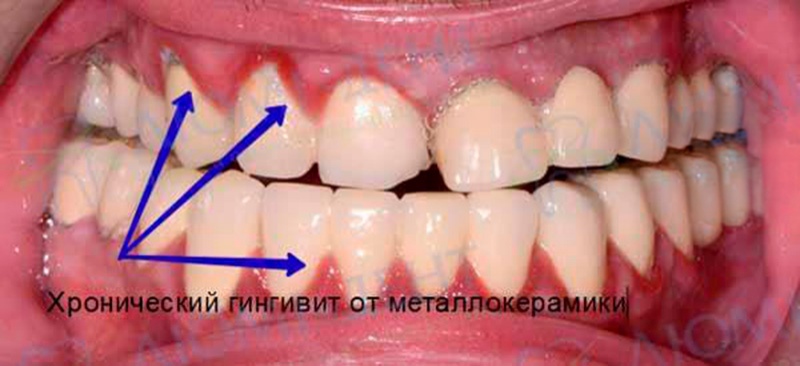 Хронический гингивит возле металлокерамических коронок Металлокерамика зубов Киев фото Люми-Дент