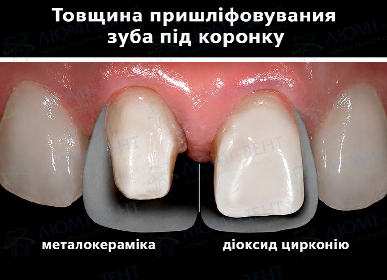 Різниця між препаруванням під металокераміку і суцільнокерамічну коронку Металокерамічна коронка на зуб Київ фото Люмі-Дент
