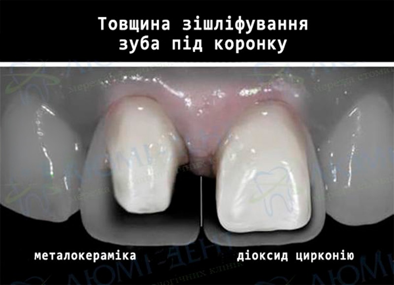 Металокерамічна коронка на зуб Київ фото Люмі-Дент