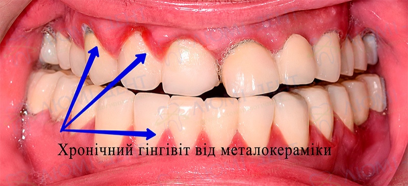 Хронічний гінгівіт біля металокерамічних коронок Металокерамічні зуби фото Люмі-Дент