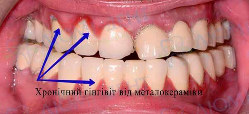 Металокерамічні зуби фото Люмі-Дент
