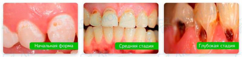 Стадии пришейкового кариеса Кариес пришейковый фото Люми-Дент