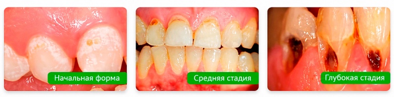 Карієс пришийковий фото Люмі-Дент