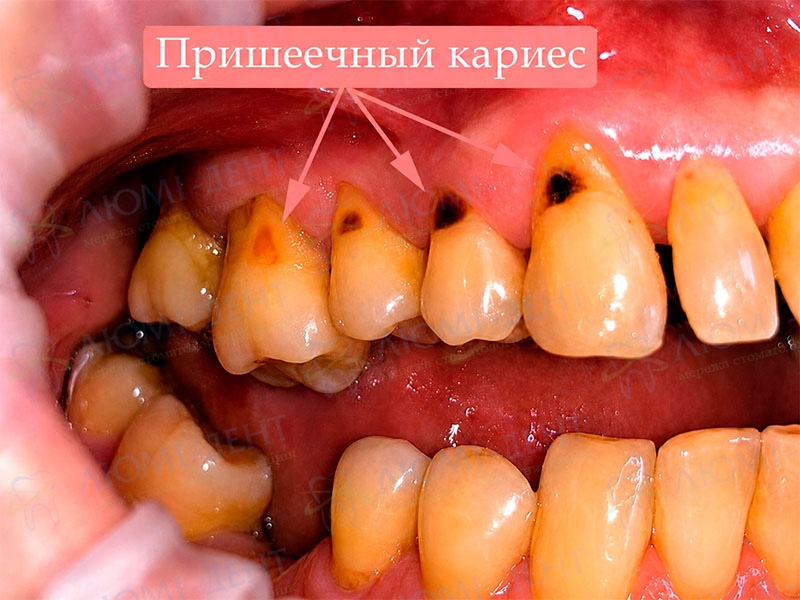 Пришеечный кариес фото Люми-Дент