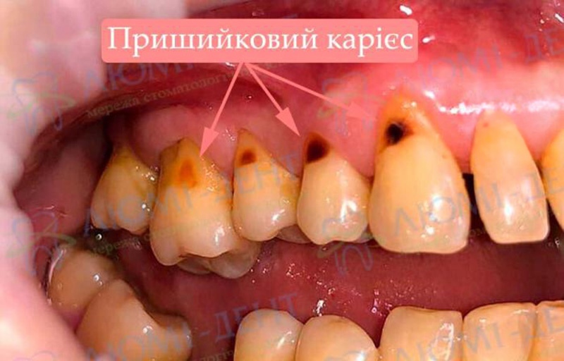 Пораженные зубы кариесом в области шейки Пришеечный кариес фото Люми-Дент
