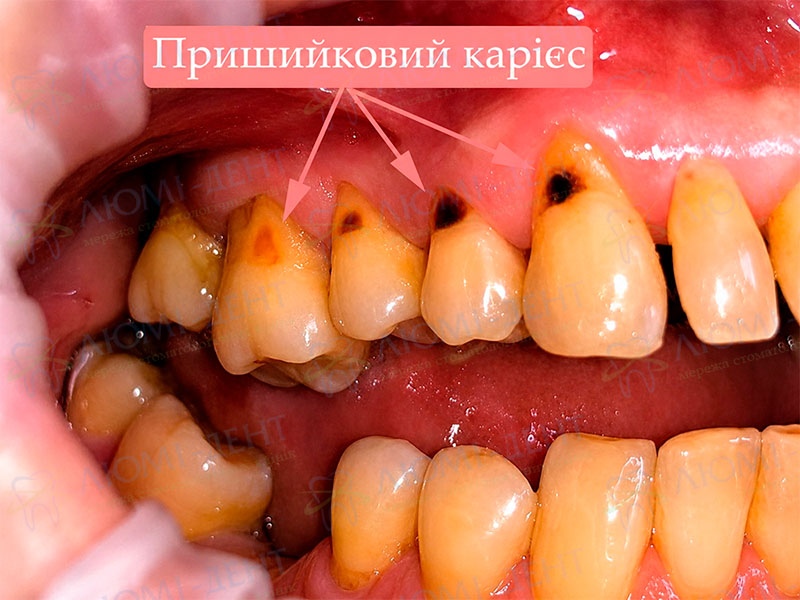 Уражені зуби карієсом в області шийки Пришийковий карієс фото Люмі-Дент