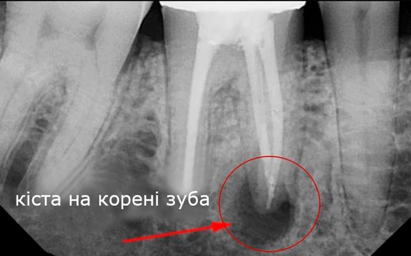 Фото після резекції кореня зуба Що таке резекція фото Люмі-Дент