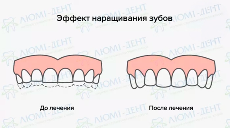 Наращивание передних зубов фото ЛюмиДент
