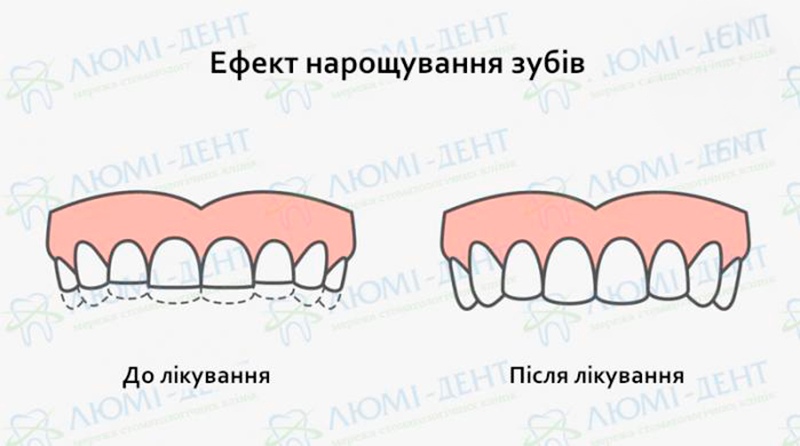 Ефект нарощування зубів Нарощування передніх зубів фото ЛюміДент
