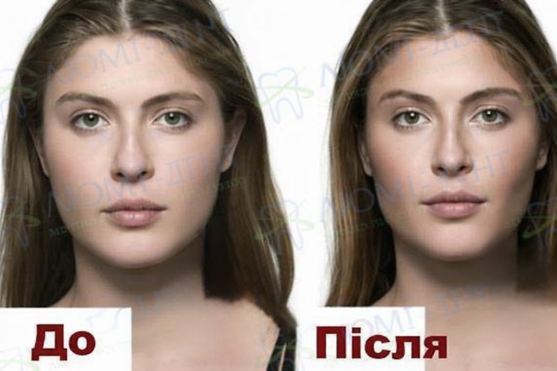 Фото до та після видалення грудок Біша
