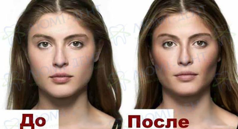 Фото до и после удаления комков Биша Фото до и после удаления комков Биша