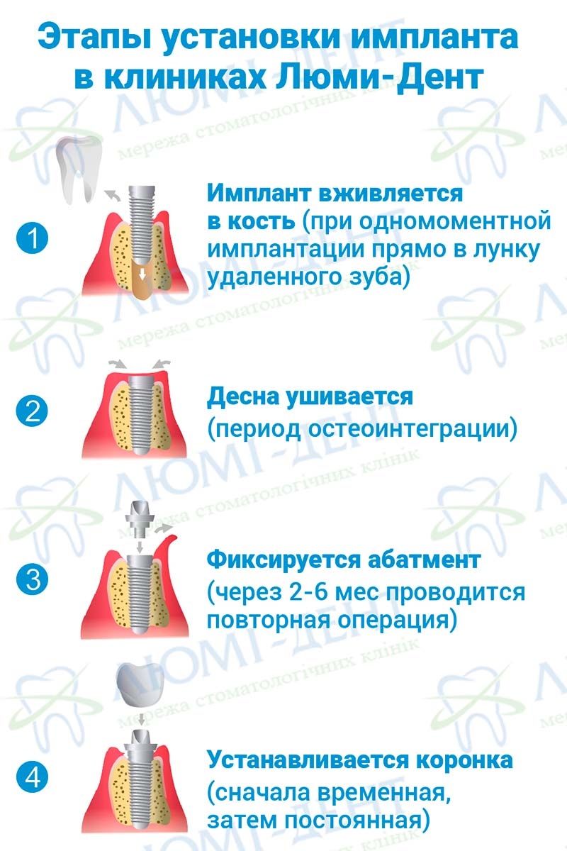 Этапы установки импланта на зубы Недорогие зубные импланты фото ЛюмиДент
