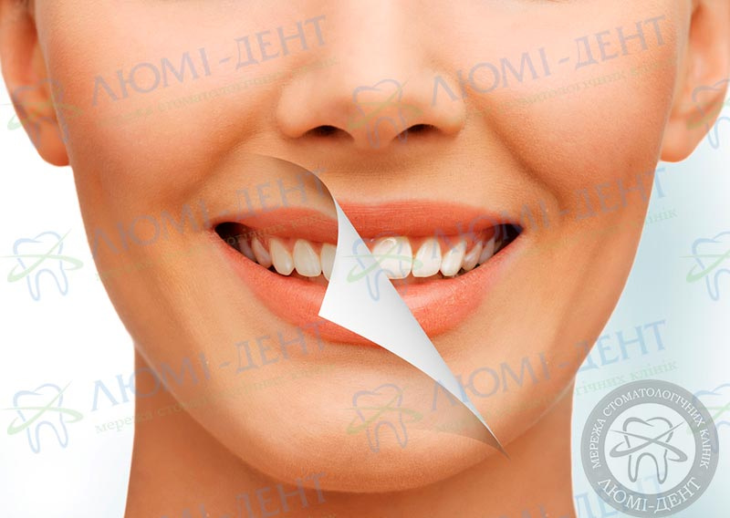 Как отбелить зубы в DentalPark