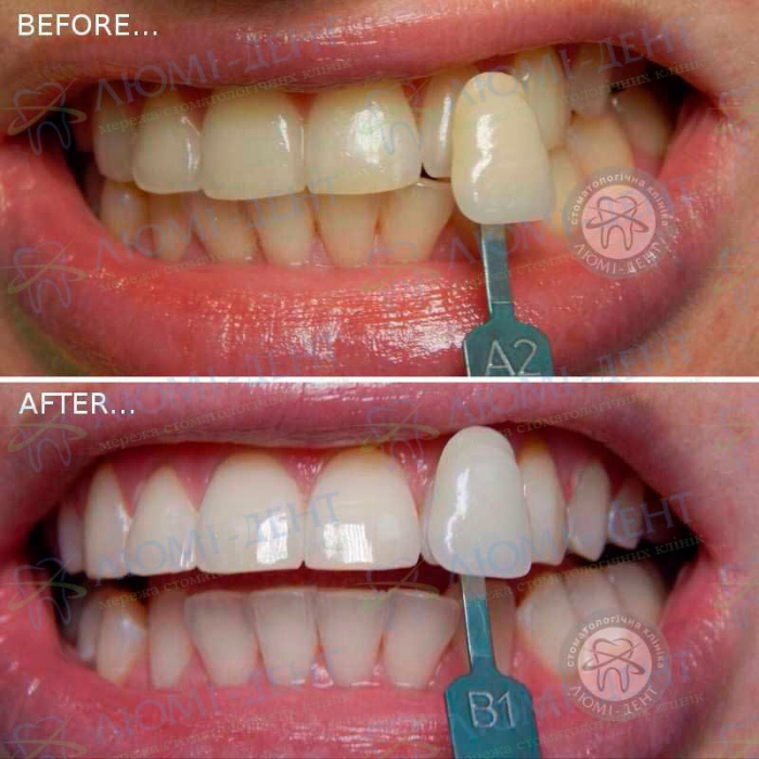 Як відбілити зуби содою фото Люмі-Дент