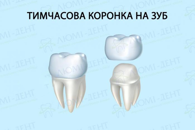 Тимчасова коронка фото Люмі-Дент