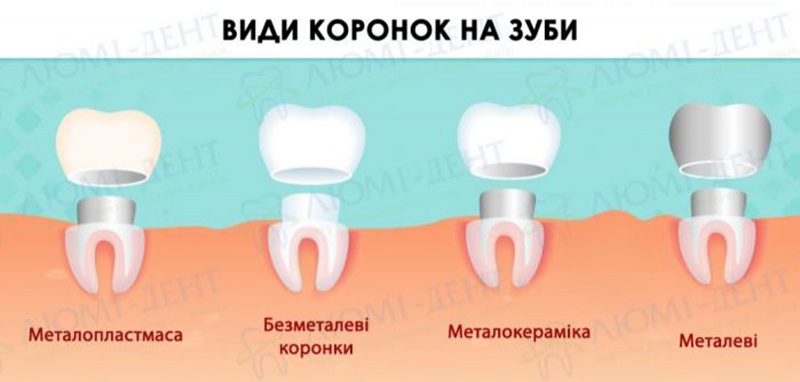 Тимчасова коронка на імплант фото Люмі-Дент