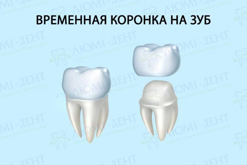 Модель временной коронки на зуб Временная коронка фото Люми-Дент