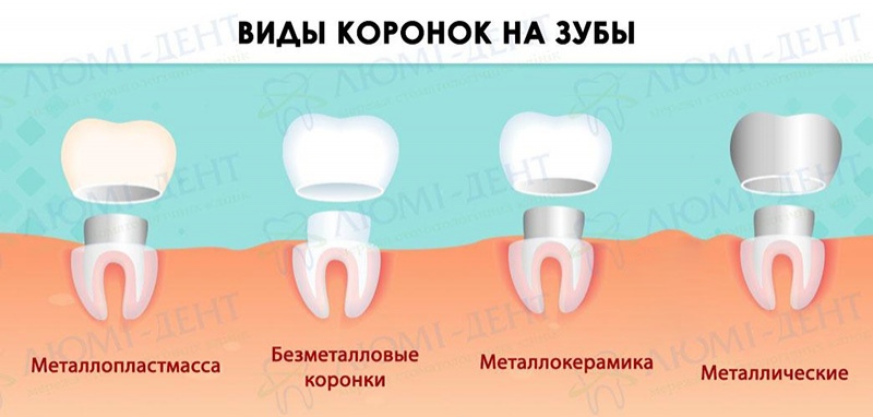 Виды зубных коронок Временная коронка на имплант фото Люми-Дент