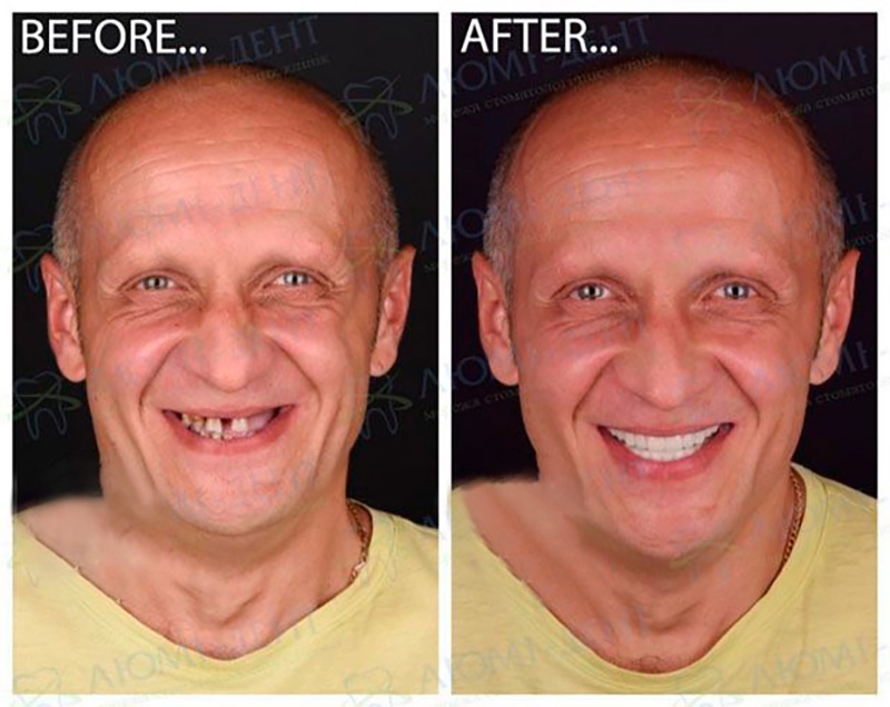 Dental-Implants-Lumi-Dent