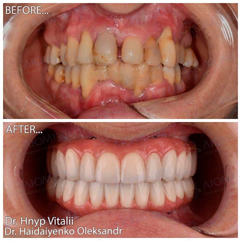  Dental implantation photo Lumi-dent