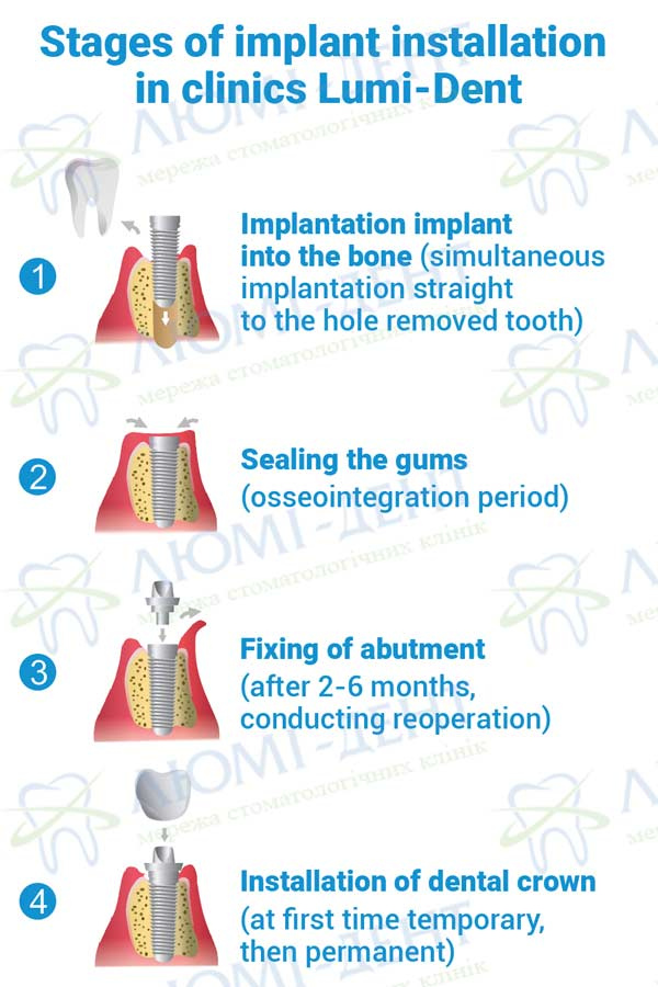 Types of dental implants photo Lumi-Dent