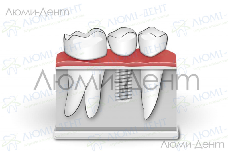 Як виглядає імплант зуба фото Люмі-дент