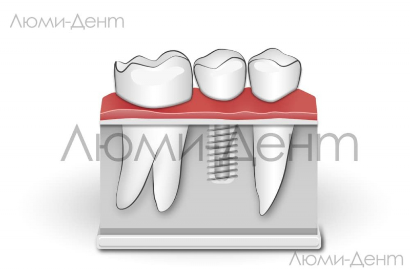 Імплантація зубів Київ зубні імпланти фото Люмі-Дент