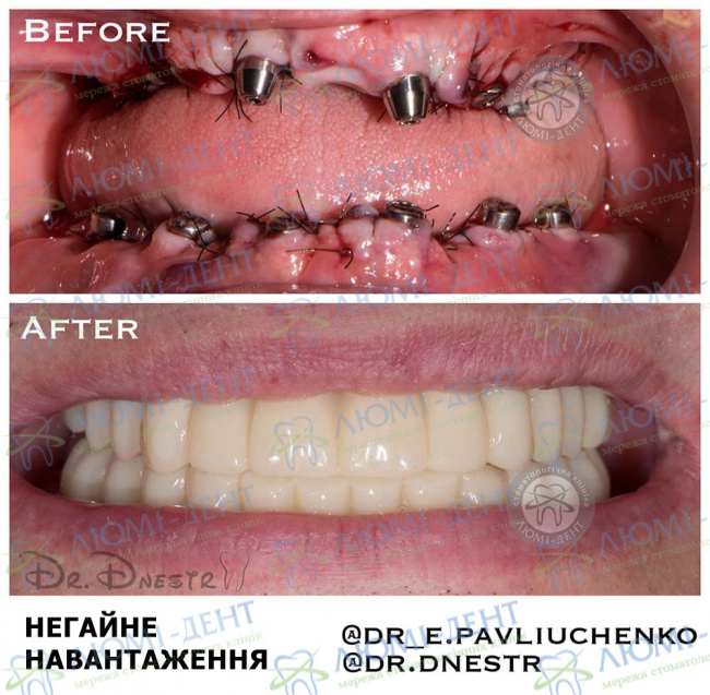Приживлюваність імплантів зубів фото Люмі-Дент