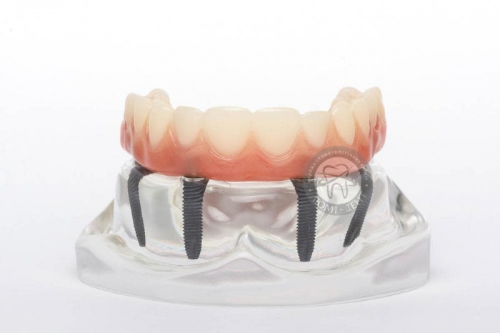 Имплантаты зубов all on 4 фото Люмидент