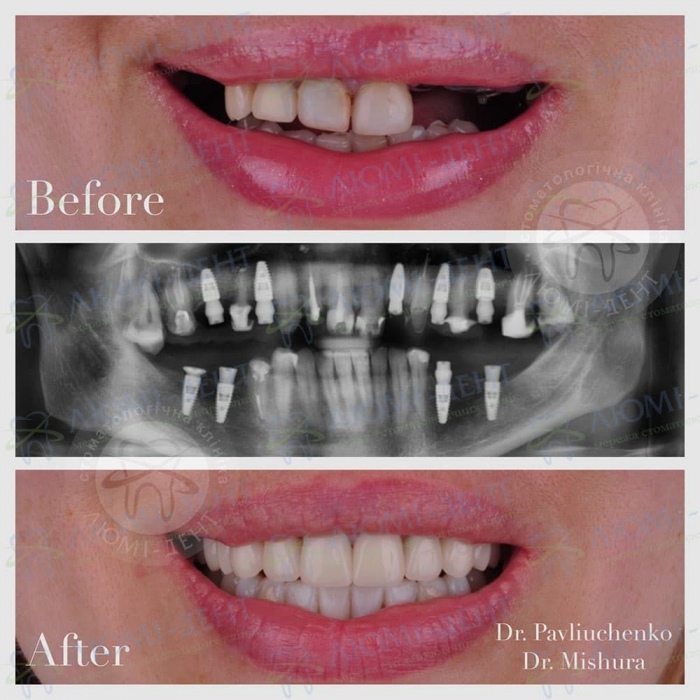 Гарантія на імплантацію зубів фото Люмі-Дент