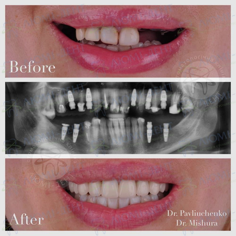 Гарантия на имплантацию зубов фото Люми-Дент