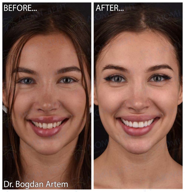 Teeth Restoration with Veneers: Before and After Photos Before-and-after photos of a patient treated at the clinic in Obolon