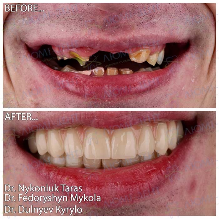 Dental Implants: Before and After Photos Before-and-after photos of a patient treated at the clinic in Obolon