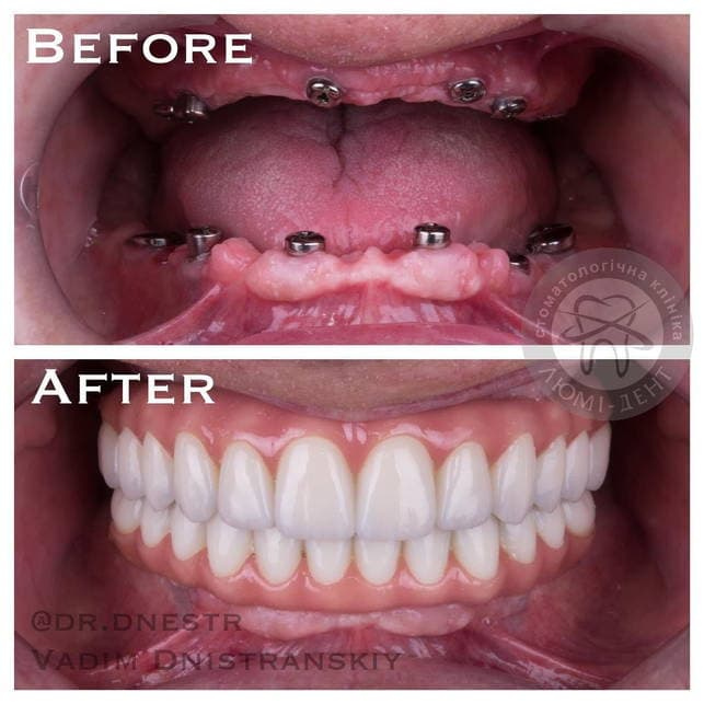 Teeth dental implantation pics LumiDent