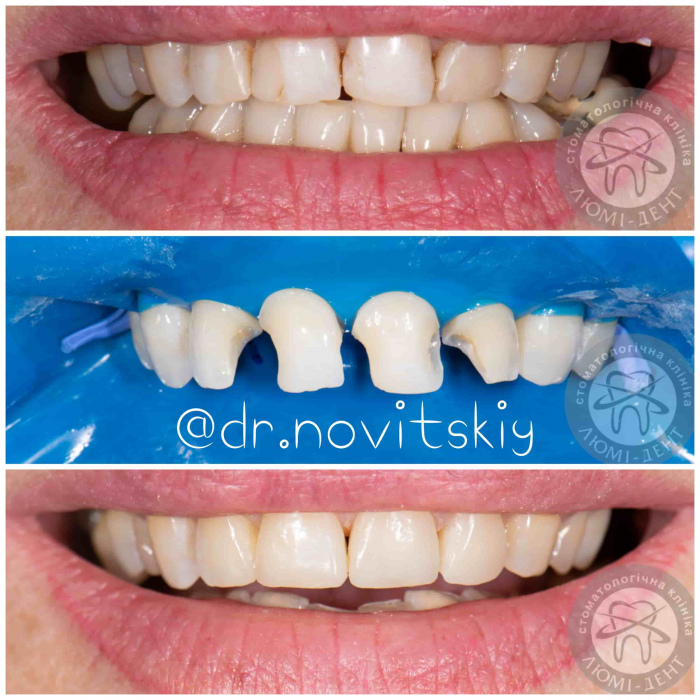Художня реставрація зубів фото Люмі-Дент