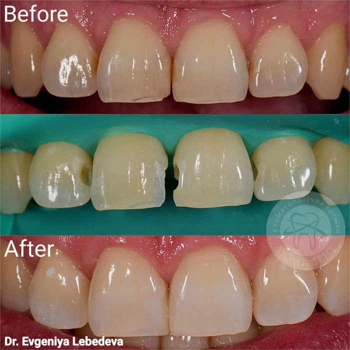 Нарощування зуб на зуб реставрація фото Люмідент