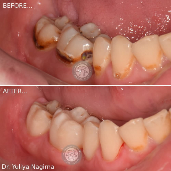 Dental filling photo before and after Lumi-Dent