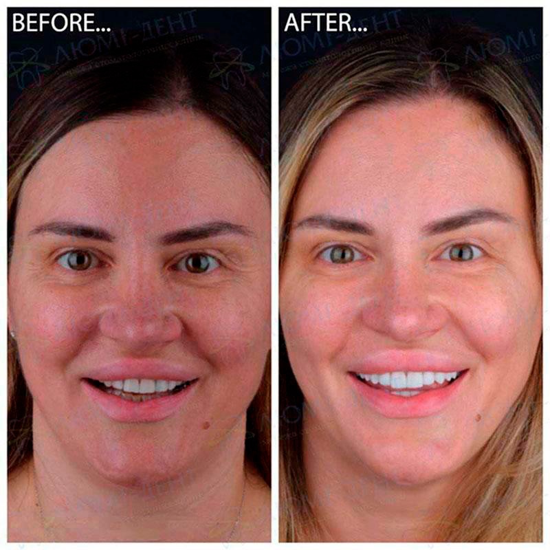 Teeth Restoration with Veneers: Before and After Photos Teeth Restoration with Veneers: Before and After Photos