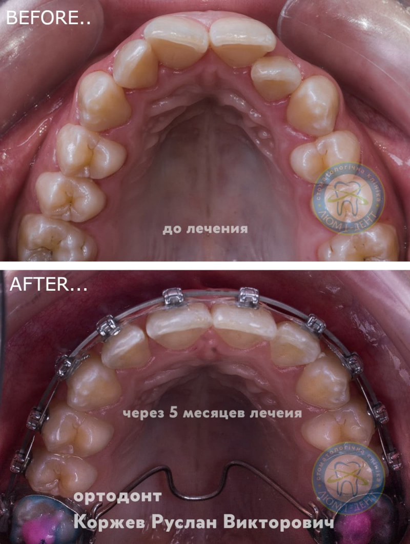 Які брекети краще носити фото Київ Люмі-Дент