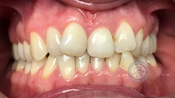 Types of malocclusion of teeth photo Lumi-Dent Kyiv