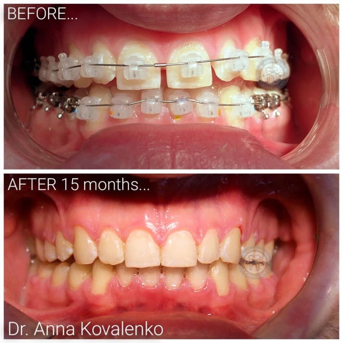 Malocclusion of teeth in an adult Lumi-Dent