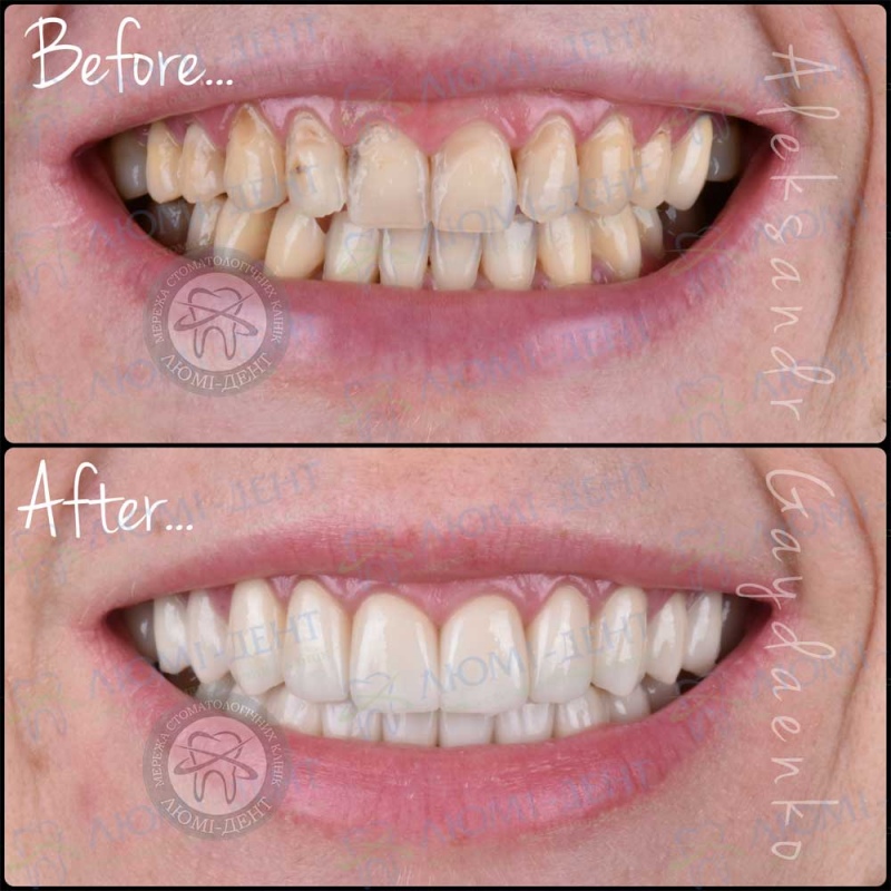 До и после установки виниров в Люми-Дент Альтернатива коронкам на зубы фото Люми-Дент