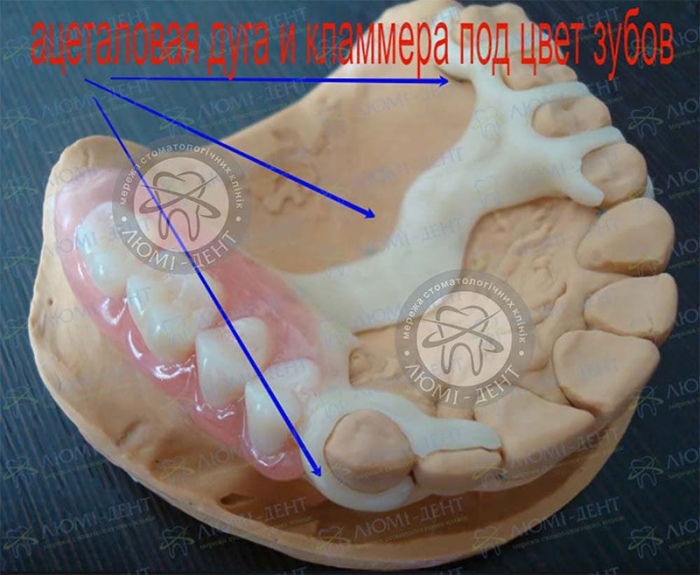 Частичный съемный протез фото Люми-Дент