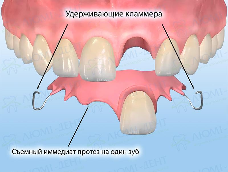 Съемный иммедиат протез на один зуб фото Люми-Дент